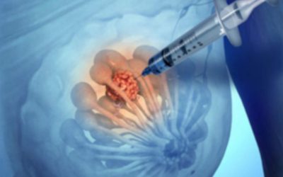 Macrobiopsie mammaire