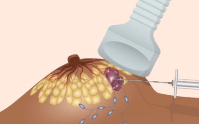 Pose de clip radio-opaque