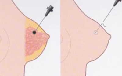 Repérage préopératoire