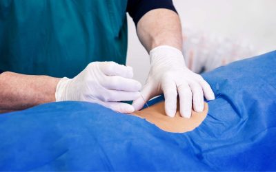 Infiltration radioguidée